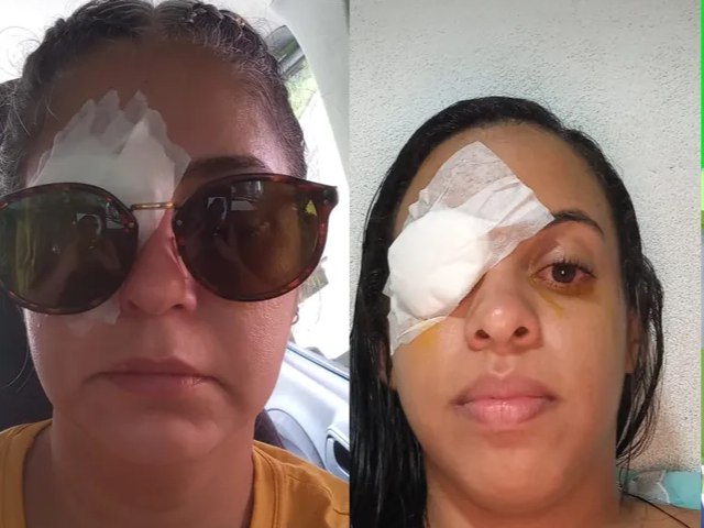 Produtos de cabelo levam mais de 100 pessoas para emergências oftalmológicas após prévias carnavalescas no Recife e em Olinda