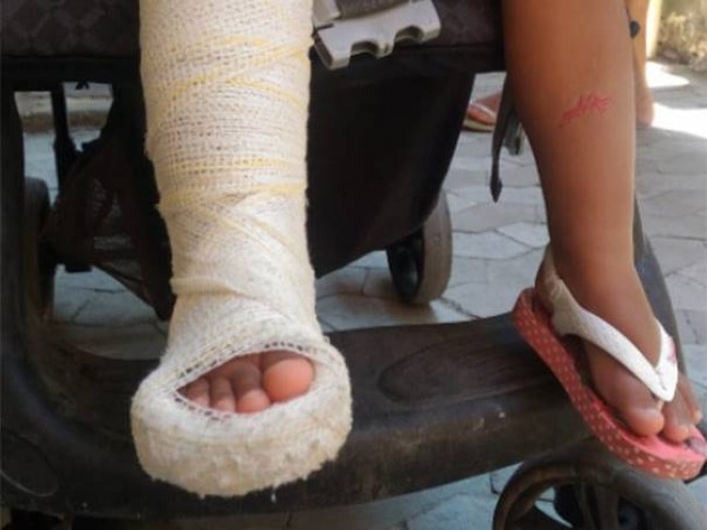 Me quebra a perna de menina de 6 anos com cabo de vassoura na regio metropolitana