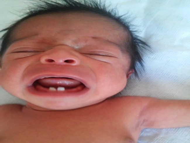 Em caso raro, beb nasce com dois dentes e surpreende pais