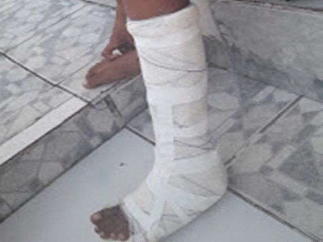 So Jos do Jacupe: Garoto de 10 anos tem perna quebrada aps motorista errar a marcha do carro