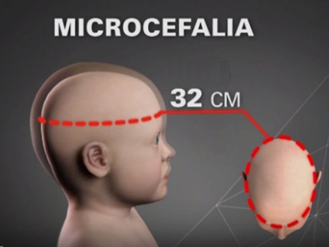 Microcefalia pode levar aborto de novo ao STF