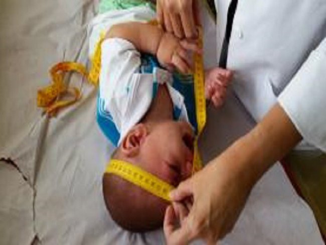 Microcefalia: 81% dos diagnósticos concluídos em PE um ano após nascimento dos primeiros bebês da era zika