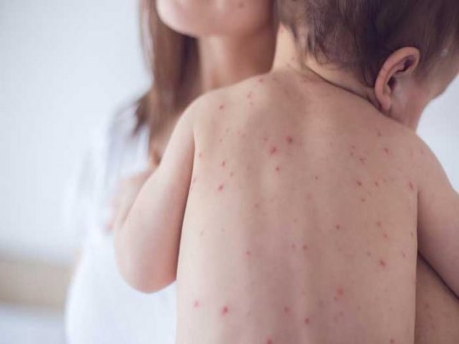 Após surto de sarampo no Norte do país, Salgueiro vacinará contra a doença em agosto