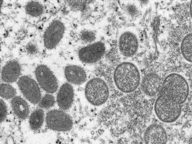 Secretaria de Saúde notifica primeiro caso suspeito de varíola dos macacos em Pernambuco