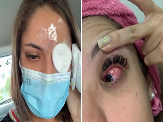 Cegueira temporria: uso de produto capilar leva mais de 200 mulheres para hospital em Pernambuco 