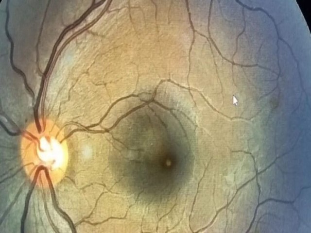 Nordestina  diagnosticada com leso no olho aps ver eclipse solar sem proteo