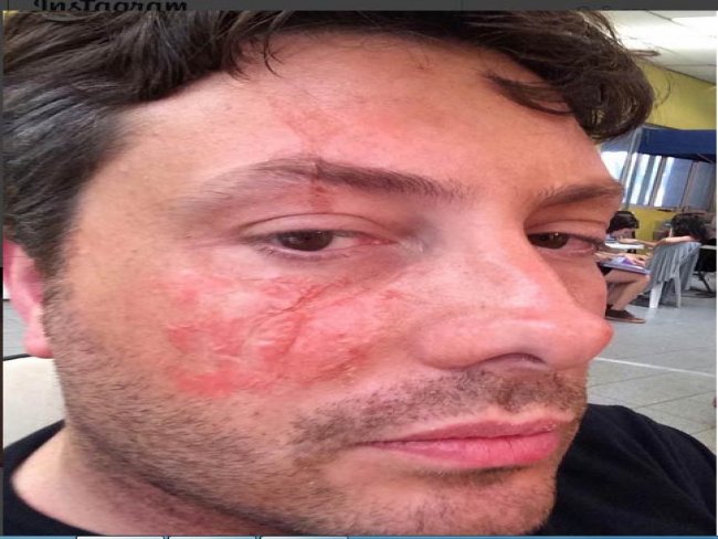Panela de pressão provoca queimadura no rosto de Danilo Gentili