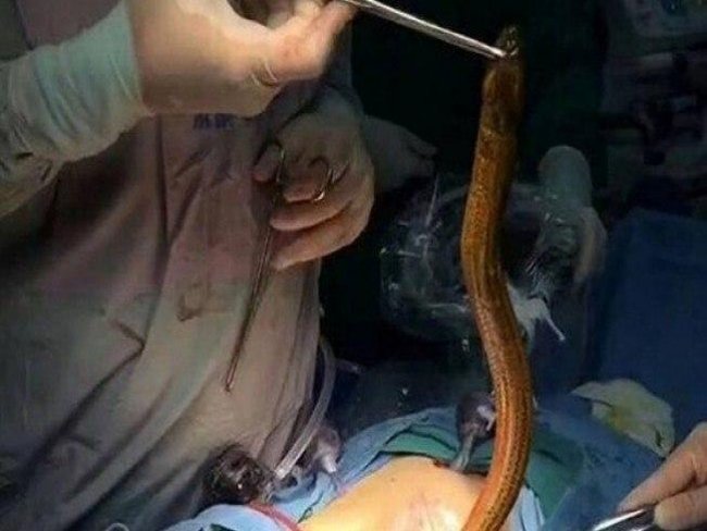 Homem faz cirurgia para retirar enguia de dentro do seu ânus