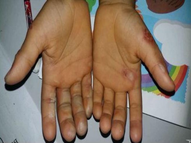 Criança tem mãos queimadas após pegar dinheiro da mãe em Codó