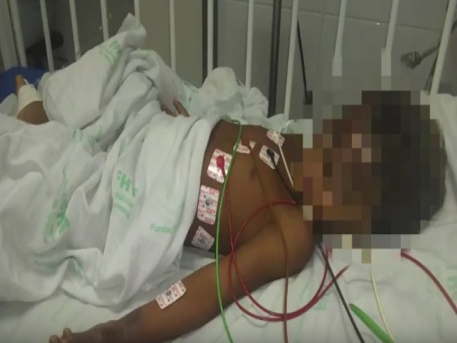 Criança tem corpo queimado após incêndio na zona Sul de Teresina