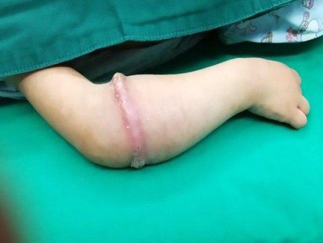 Menina quase perde o braço após elástico se 'infiltrar' na pele