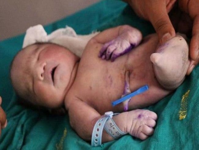 Com 'Síndrome da Sereia', bebê morre 15 minutos após nascer