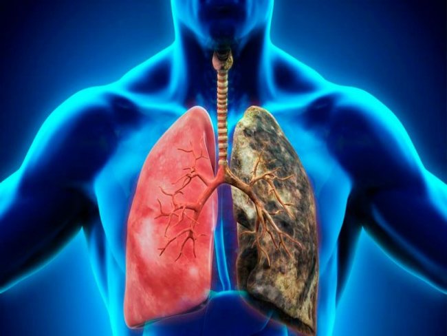 Anvisa aprova nova combinação de drogas para câncer de pulmão