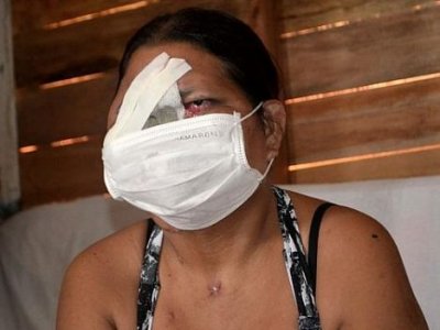 Mulher perde boca, nariz e um olho aguardando por cirurgia no Amapá