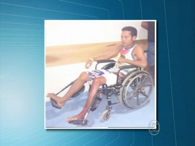 Surfista é ferido na perna e diz ter sido atacado por tubarão em Olinda