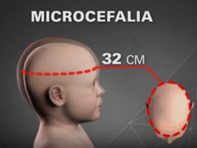 Pernambuco confirma 123 dos 1.306 casos notificados de microcefalia