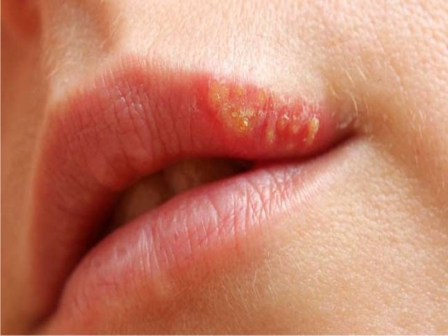 Herpes labial pode querer dizer uma dessas oito coisas sobre sua sade