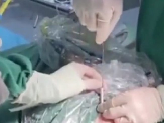 Menino de 10 anos coloca fio de metal no pnis por 'tdio' e precisa de cirurgia urgente