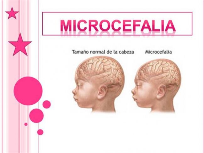 Quatro casos de microcefalia so notificados em Petrolina, Trindade e Santa Filomena
