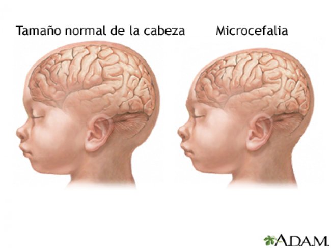 Ouricuri j registrou 13 casos de microcefalia