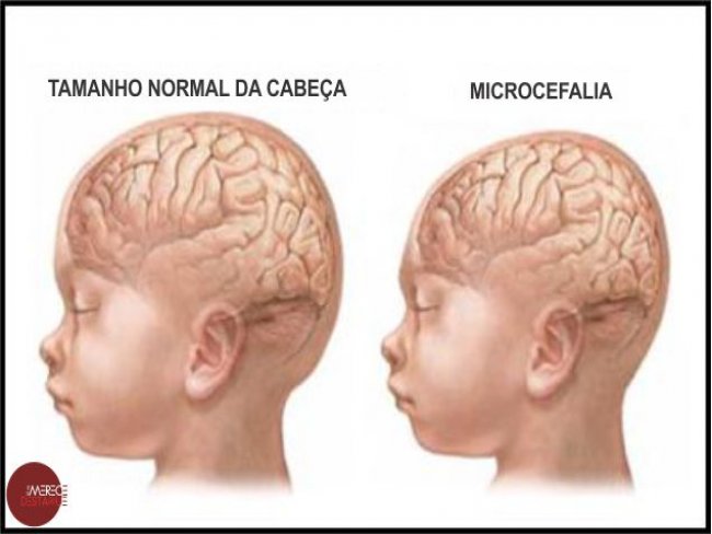 Pernambuco atinge marca de 804 casos suspeitos de microcefalia