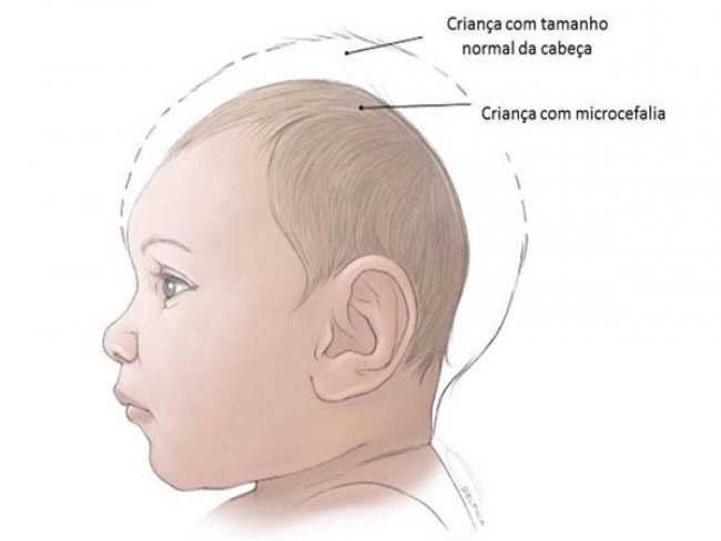 Beb com microcefalia nasce sem vida em Belm do So Francisco