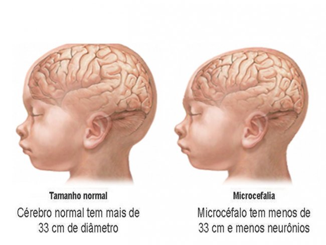 Sobe o nmero de casos suspeitos de microcefalia em Parnamirim