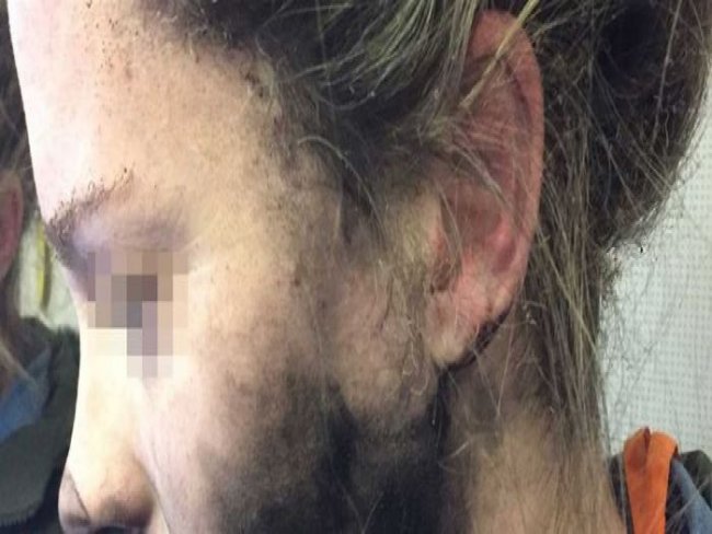 Mulher tem rosto queimado por fone de ouvido durante voo