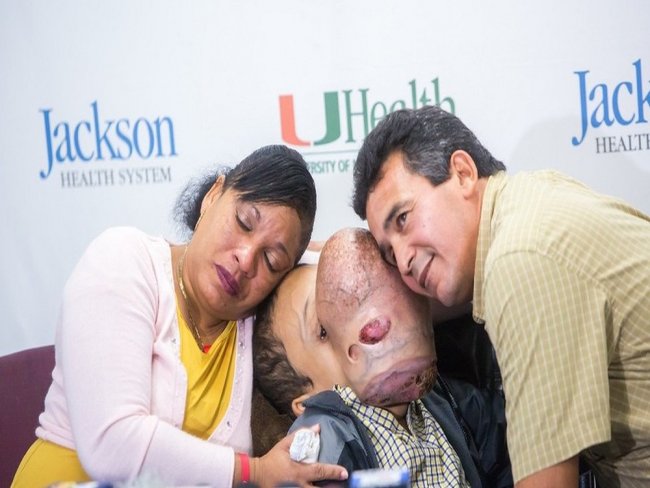 Morre Emanuel, o adolescente cubano que tinha um enorme e raro tumor no rosto, aps ser operado nos EUA