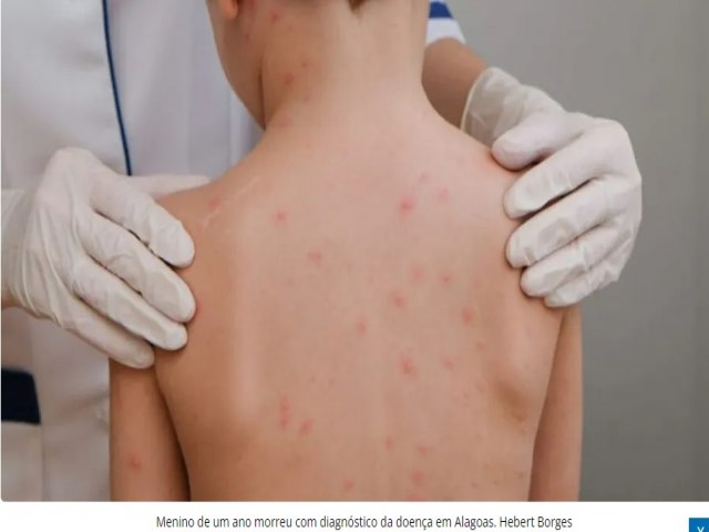 Alagoas j soma 10 casos de meningite; bitos chegam a seis