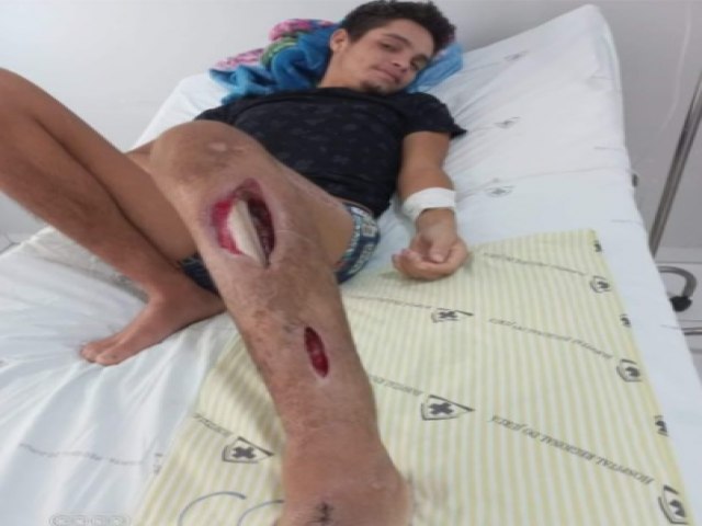 Agricultor de Mncio Lima que foi picado por cobra pico de jaca corre risco de perder a perna por falta de apoio do governo