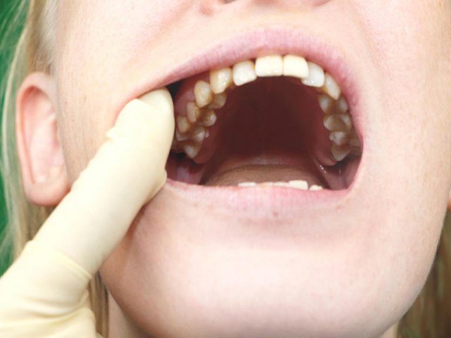 Crescem os casos de cncer de boca entre jovens; veja as causas