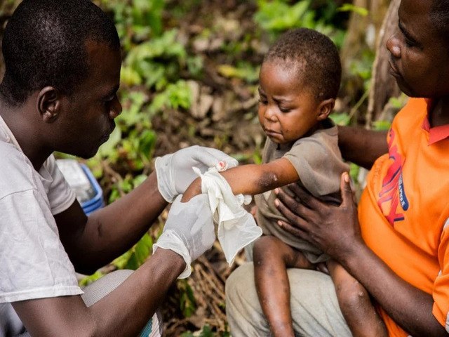 OMS monitora surto de varíola dos macacos em 11 países e confirma 80 casos pelo mundo