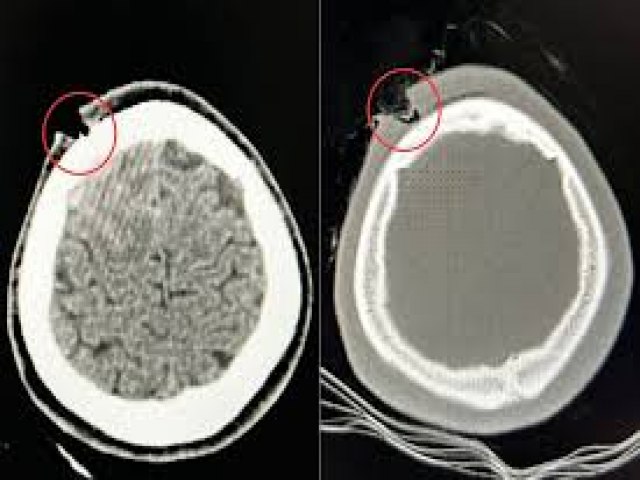 Raio-X mostra que jovem atingido por bala perdida escapou de tiro no crebro; neurologista explica os motivos